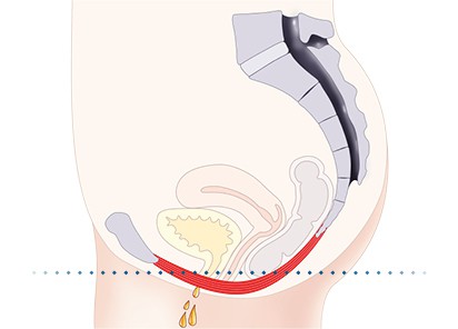 Pelvic-Floor Muscle Repair 5 Pelvic floor muscles Newbury