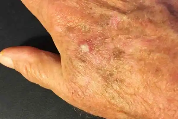 Cryopen For Actinic Keratoses 1 Image of Actinic keratoses Newbury on a person hand
